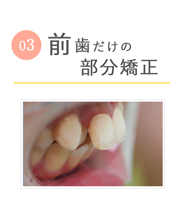 前歯だけの安いマウスピース矯正「前歯の部分矯正コース」