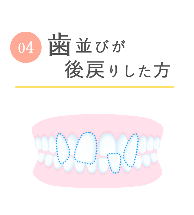 後戻りした歯の安いマウスピース矯正「再矯正コース」