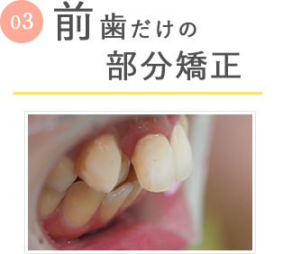 前歯だけの安いマウスピース矯正「前歯の部分矯正コース」