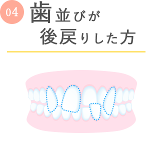 後戻りした歯の安いマウスピース矯正「再矯正コース」