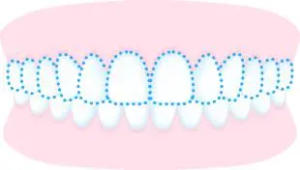 噛み合わせのずれ（深い・前歯が閉じにくい）
