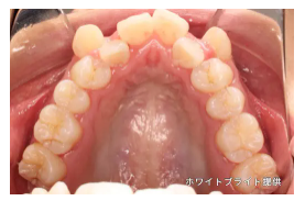 顎と歯の大きさのバランスが悪い場合