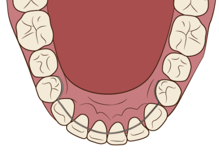 下の歯の部分矯正は可能？治療方法や適応症例、メリット・デメリットを徹底解説！