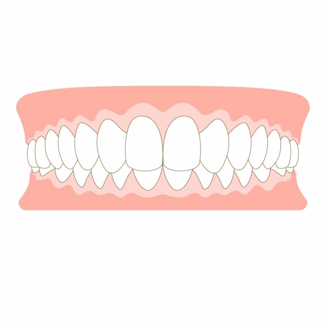 上の歯が下の歯に覆いかぶさっている