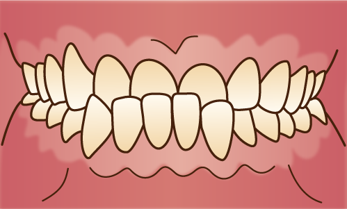下顎が前に出ている（受け口）