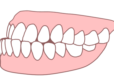 マウスピース矯正で受け口（反対咬合）は治せるのか？治療方法や費用・リスクを徹底解説