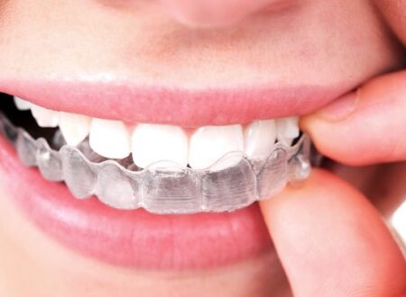 Oh my teeth（オーマイティース）とは？ 特徴や費用、治療の流れを徹底解説