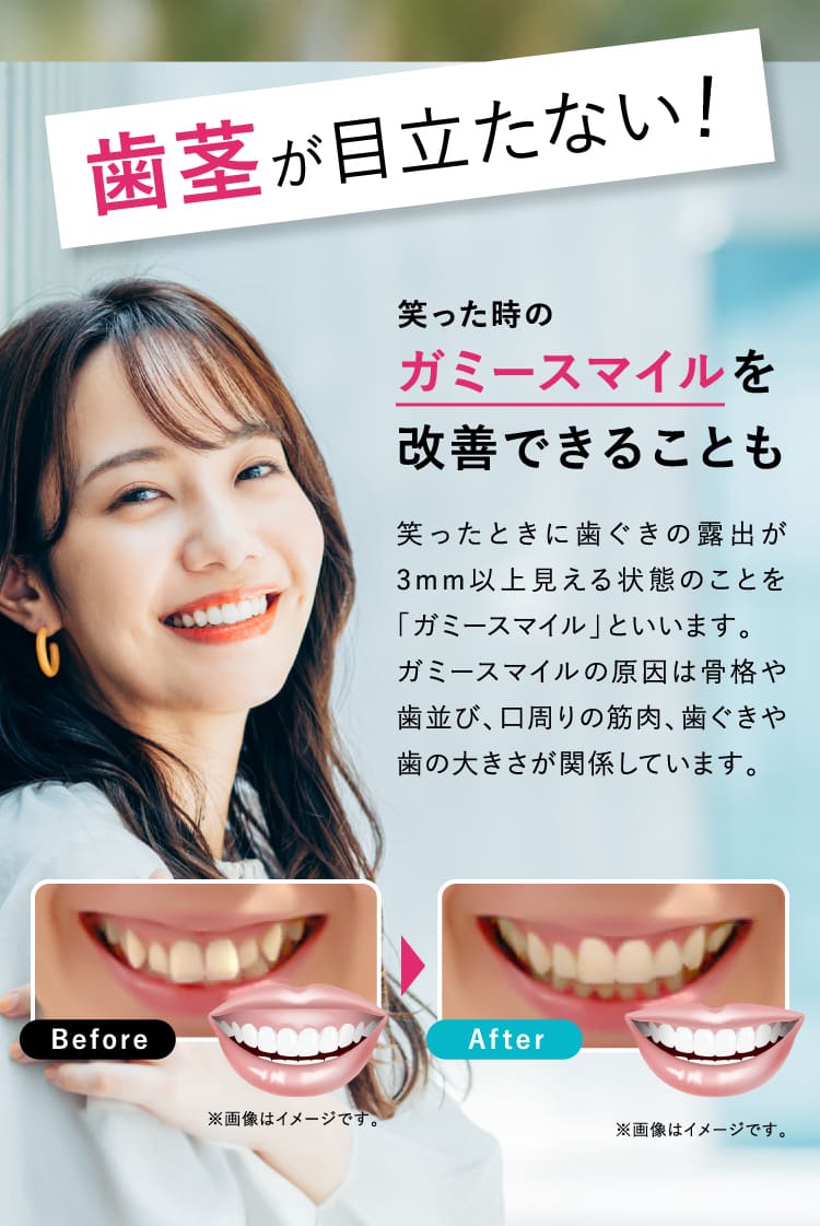 歯茎が目立たない！