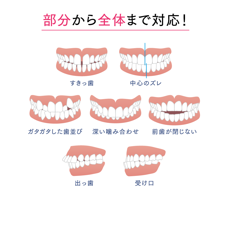 部分から全体まで対応！すきっ歯、中心のズレ、ガタガタした歯並び、深い噛み合わせ、前歯が閉じない、出っ歯、受け口