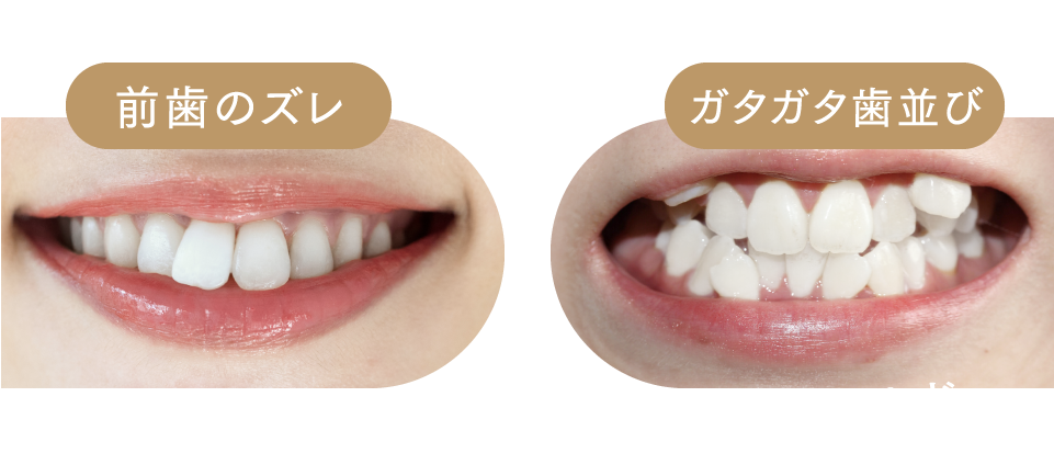 前歯のズレ・ガタガタ歯並びなどなど…