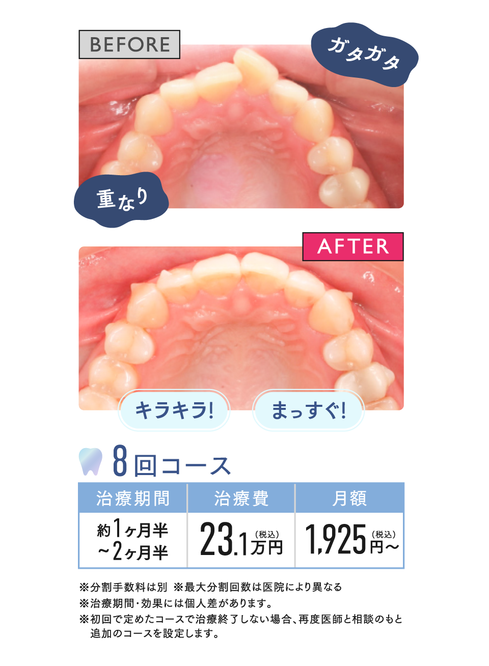 BEFORE AFTER 8回コース 治療期間約1ヶ月半～2ヶ月半 治療費23.1万円(税込) 月額1,925円〜(税込)※分割手数料は別※最大分割回数は医院により異なる※治療期間･効果には個人差があります。※初回で定めたコースで治療終了しない場合、再度医師と相談のもと 追加のコースを設定します。