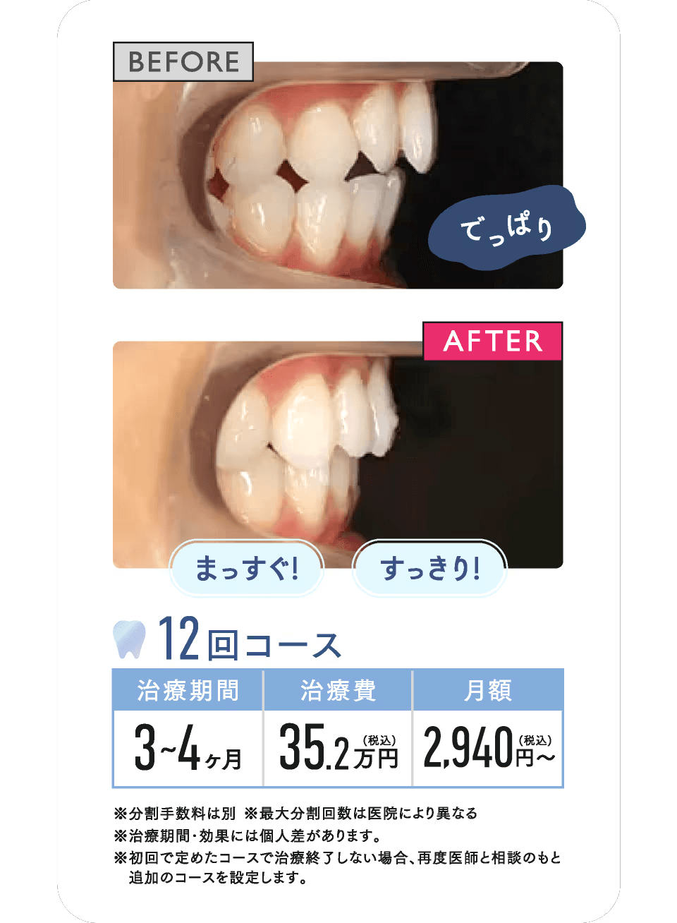BEFORE AFTER 12回コース 治療期間約3~4ヶ月 治療費35.2万円(税込) 月額2,940円〜(税込)※分割手数料は別※最大分割回数は医院により異なる※治療期間･効果には個人差があります。※初回で定めたコースで治療終了しない場合、再度医師と相談のもと 追加のコースを設定します。