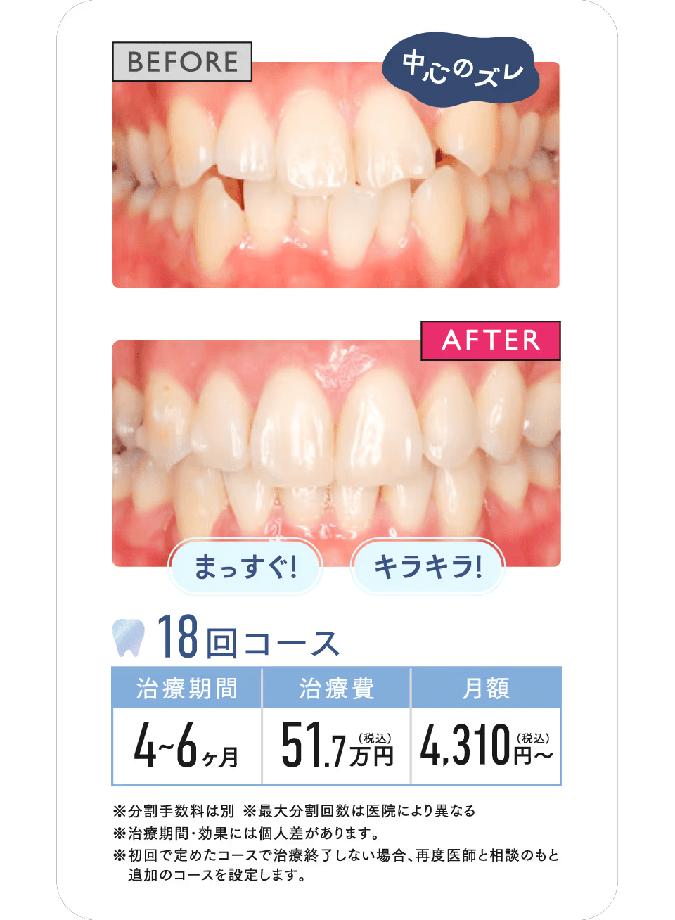 BEFORE AFTER 18回コース 治療期間約4～6ヶ月 治療費51.78万円(税込) 月額4,310 円〜(税込)※分割手数料は別※最大分割回数は医院により異なる※治療期間･効果には個人差があります。※初回で定めたコースで治療終了しない場合、再度医師と相談のもと 追加のコースを設定します。