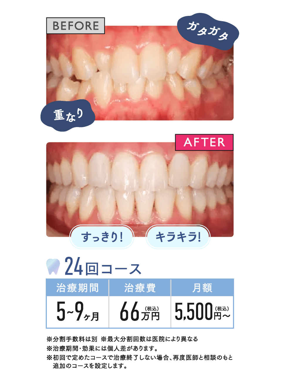 BEFORE AFTER 24回コース 治療期間約5~9ヶ月 治療費66万円(税込) 月額5,500円〜(税込)※分割手数料は別※最大分割回数は医院により異なる※治療期間･効果には個人差があります。※初回で定めたコースで治療終了しない場合、再度医師と相談のもと 追加のコースを設定します。