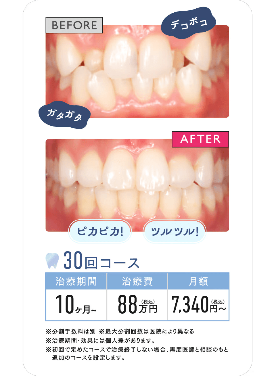 BEFORE AFTER 30回コース 治療期間約10ヶ月～ 治療費88万円(税込) 月額7,340 円〜(税込)※分割手数料は別※最大分割回数は医院により異なる※治療期間･効果には個人差があります。※初回で定めたコースで治療終了しない場合、再度医師と相談のもと 追加のコースを設定します。