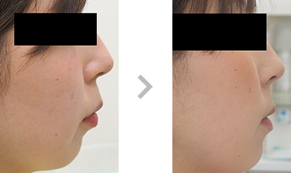 横顔美人コース 安い マウスピース矯正 ウィ スマイルは月額1760円から