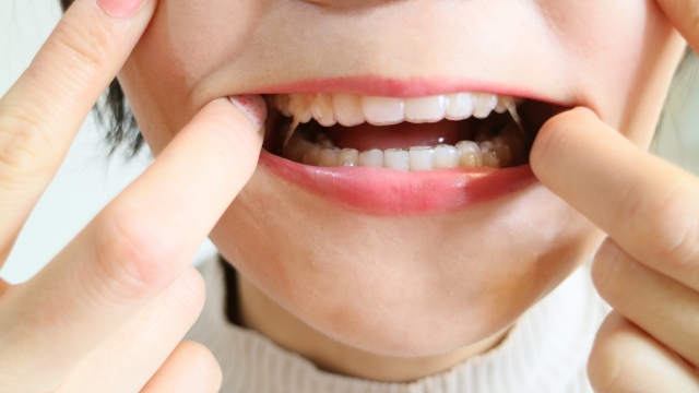 インビザラインのゴムかけが痛いのはなぜ？いつまで続く？今すぐできる対処法とは