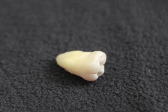 マウスピース矯正で親知らずは抜くべき？抜歯が必要なケースと不要なケース