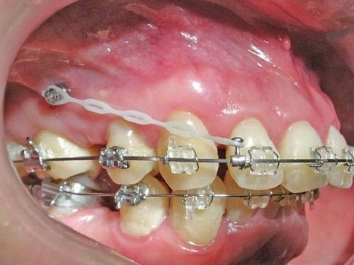 出っ歯はインプラントで治せる？矯正用インプラントの費用・期間