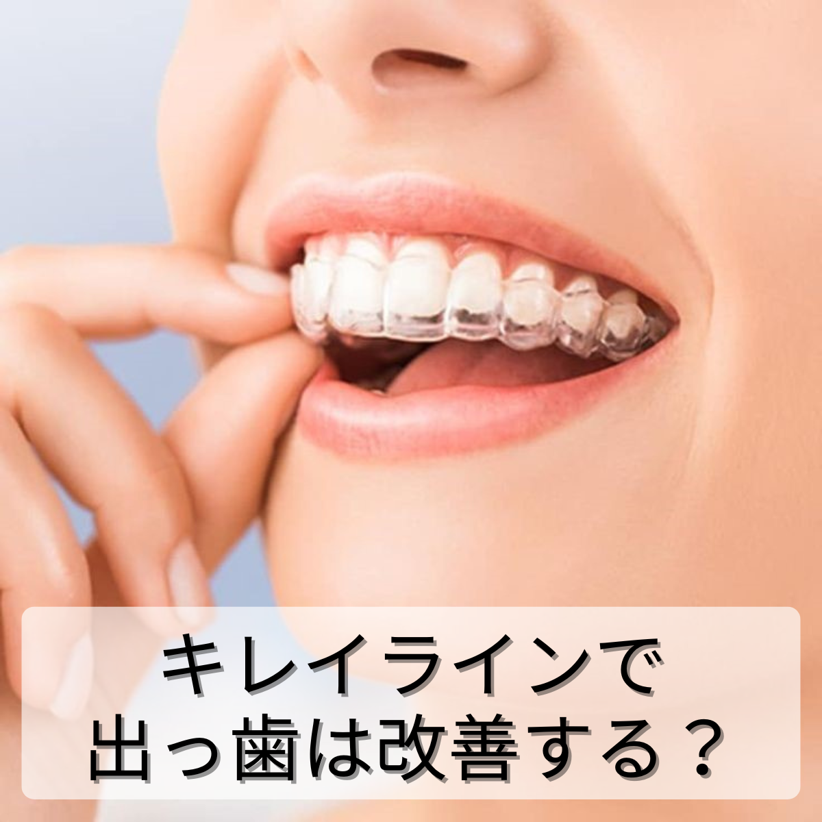 キレイラインで出っ歯は改善できる？向いている人・向いていない人の違いとは