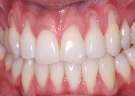 マウスピース矯正で歯茎が下がる？原因・なりやすい人の特徴と悪化を防ぐ対策