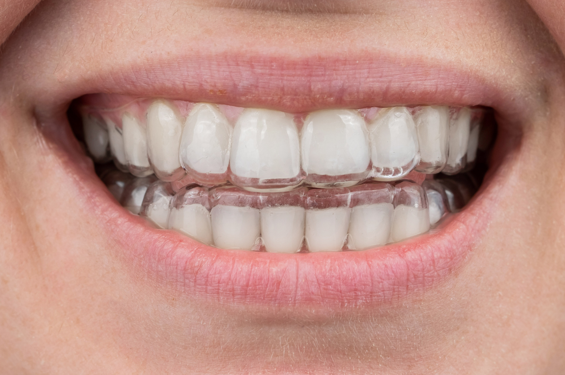 マウスピースに入れるホワイトニングジェルとは？特徴や種類、効果的な使い方も解説