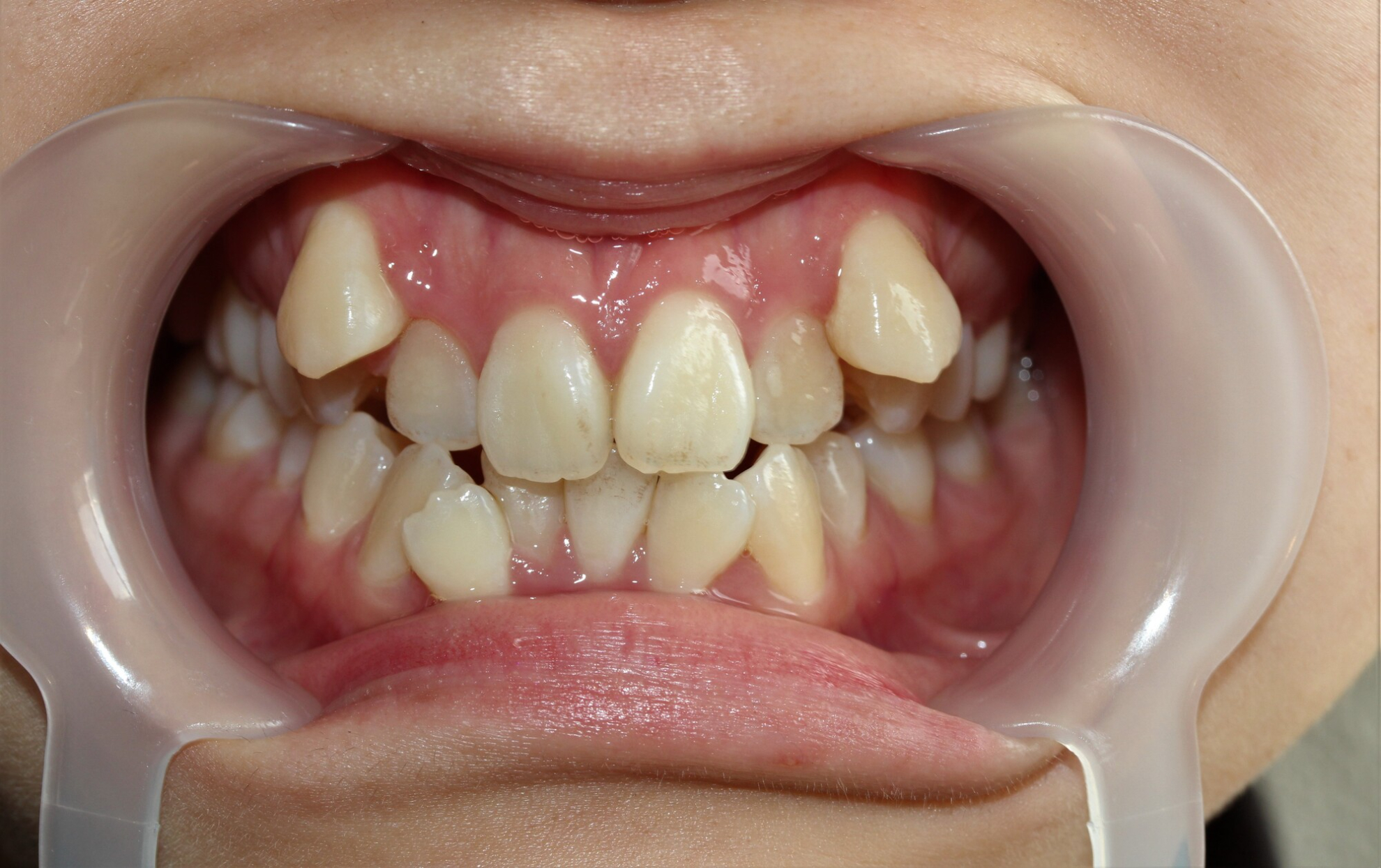 犬歯とは？八重歯との違いや役割、尖っている場合の対処法を解説