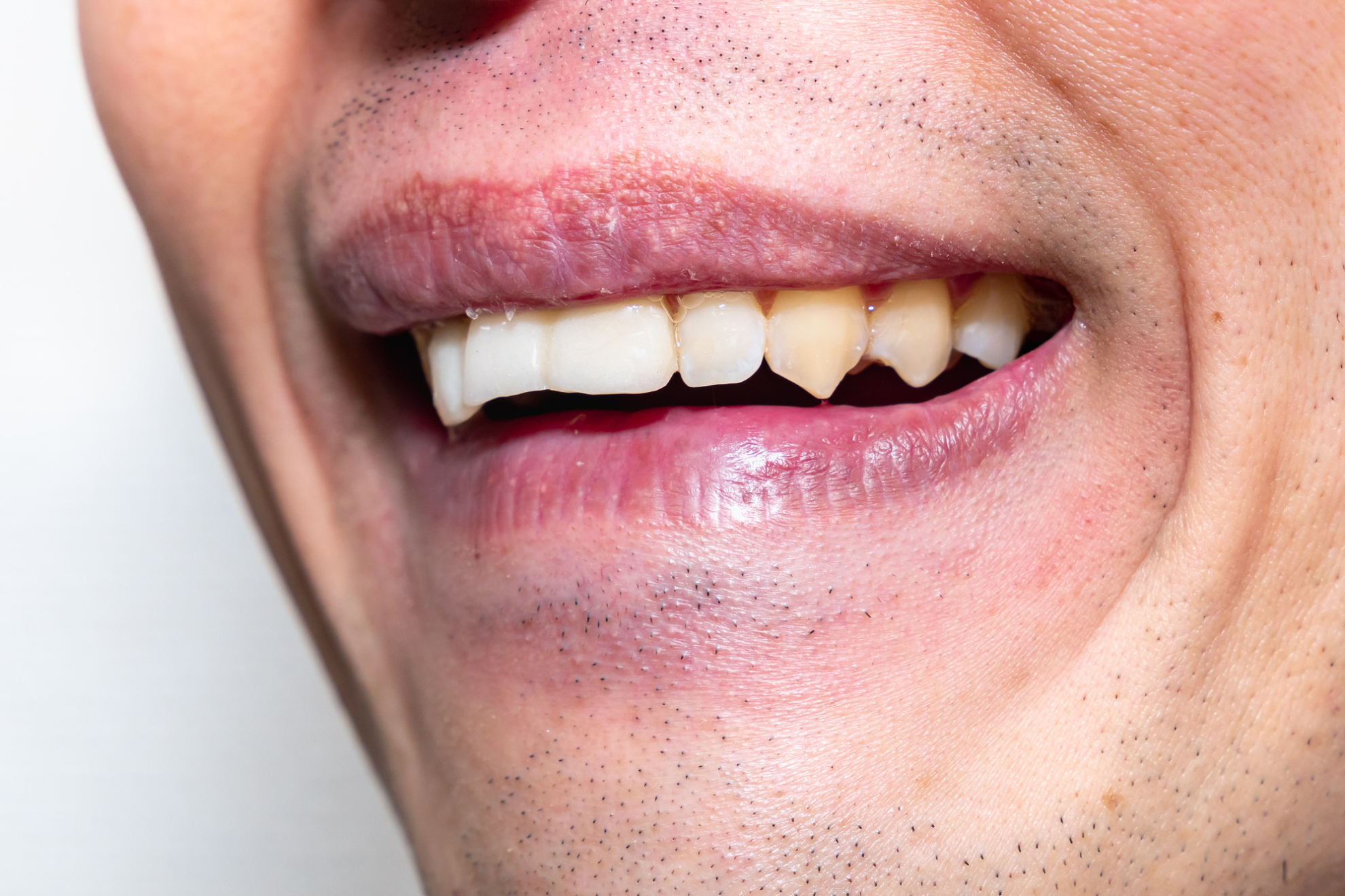 犬歯が尖ってる原因は？放置リスクや治療方法、よくある質問を紹介