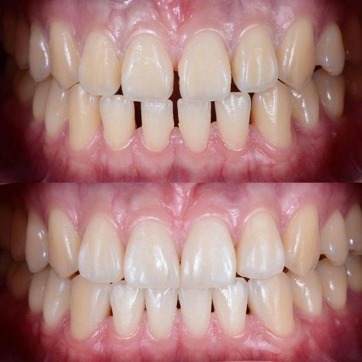 歯列矯正ですきっ歯を整えるには？矯正方法と費用・期間まとめ