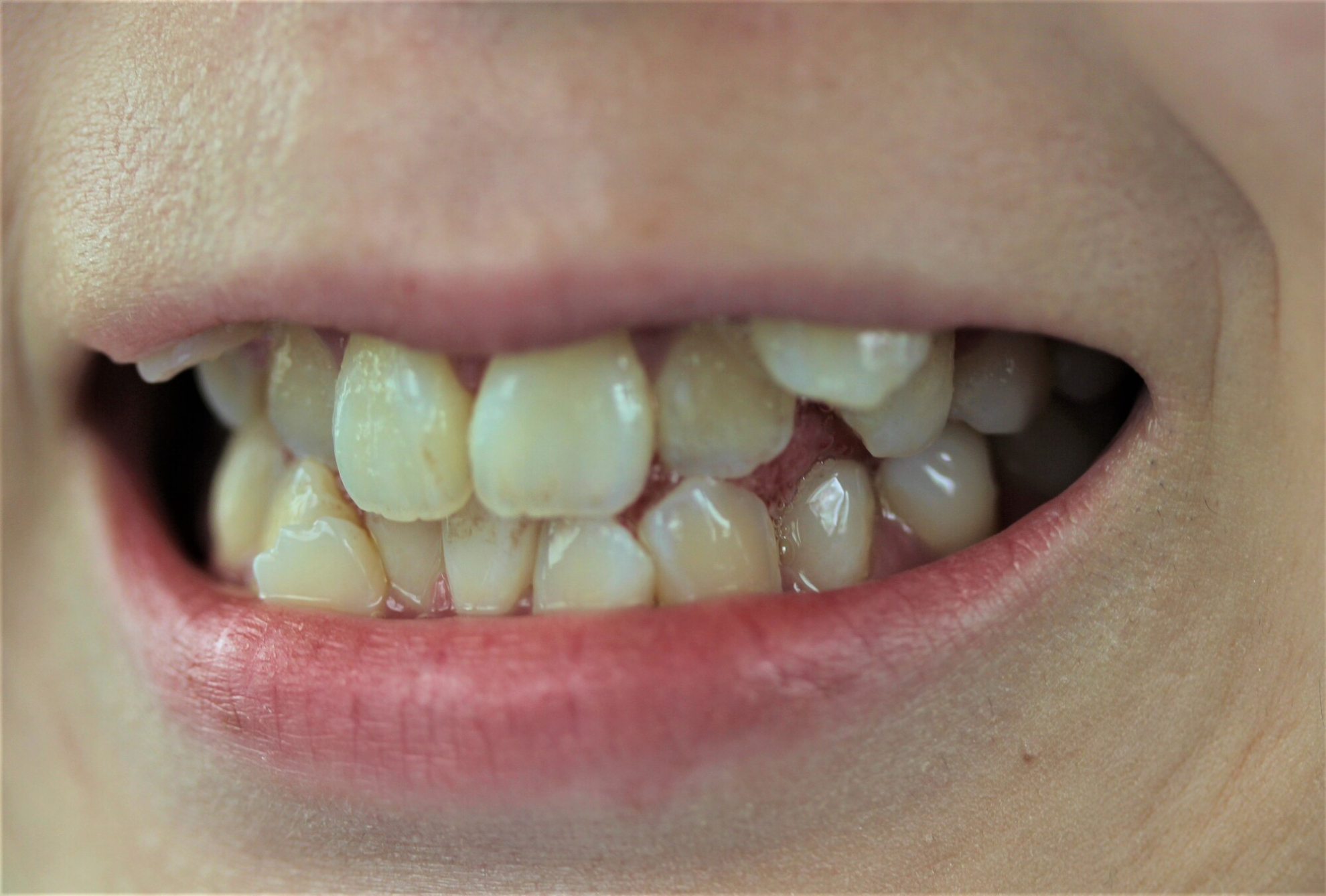 八重歯を抜くとどうなる？抜歯以外の治療法や矯正治療も紹介