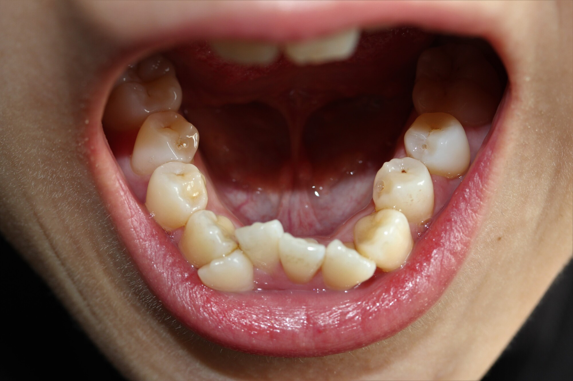 歯並びが悪い原因は？大人も子供も知っておきたい対処法や矯正方法を紹介