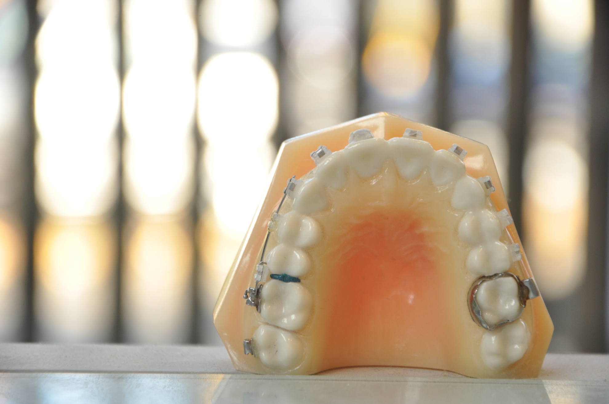 歯列矯正のバンドの役割は？使用する歯列矯正装置の種類や虫歯を防ぐケア