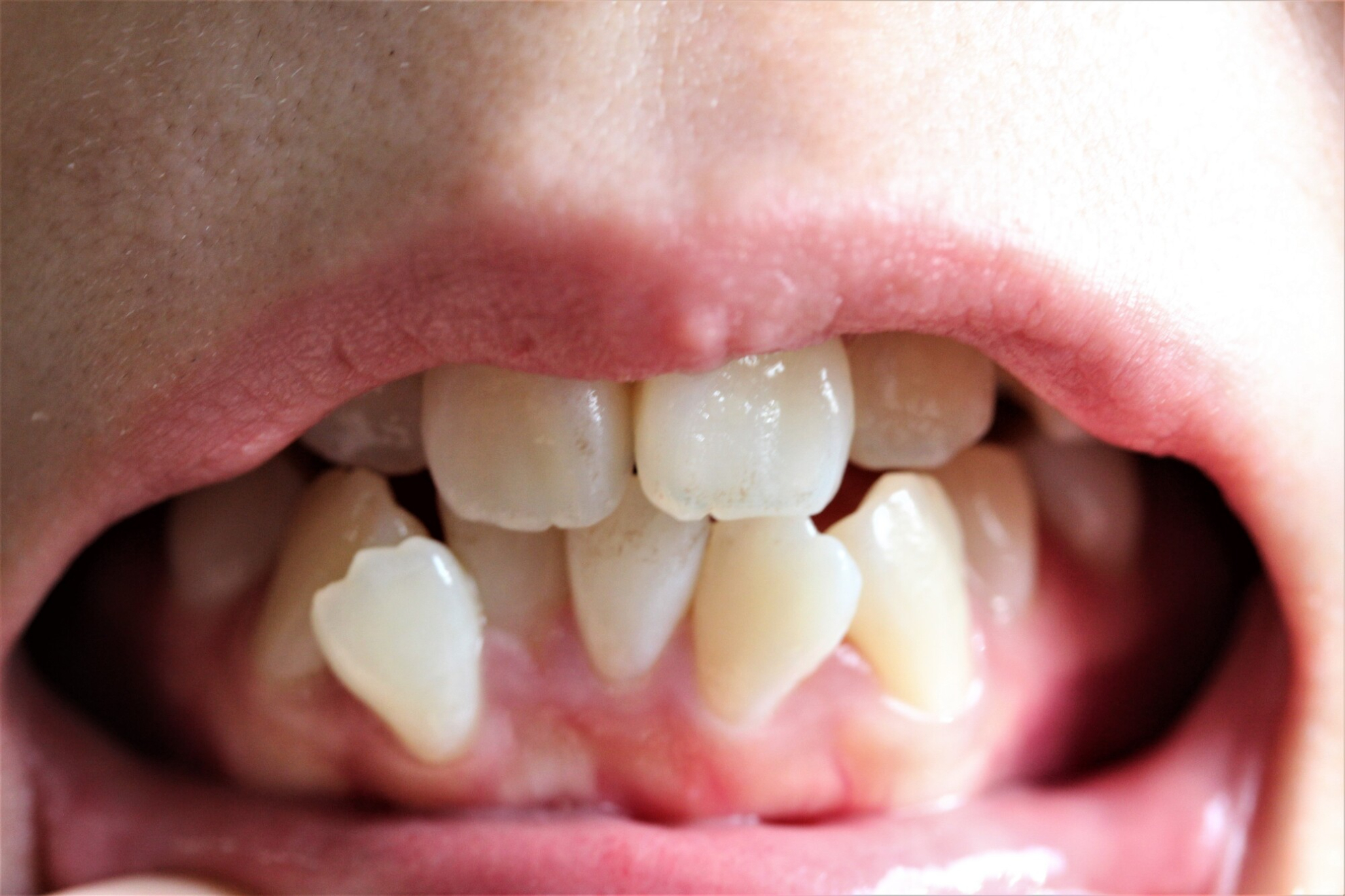 悪い歯並びとは？種類や放置するデメリット、解決方法を解説