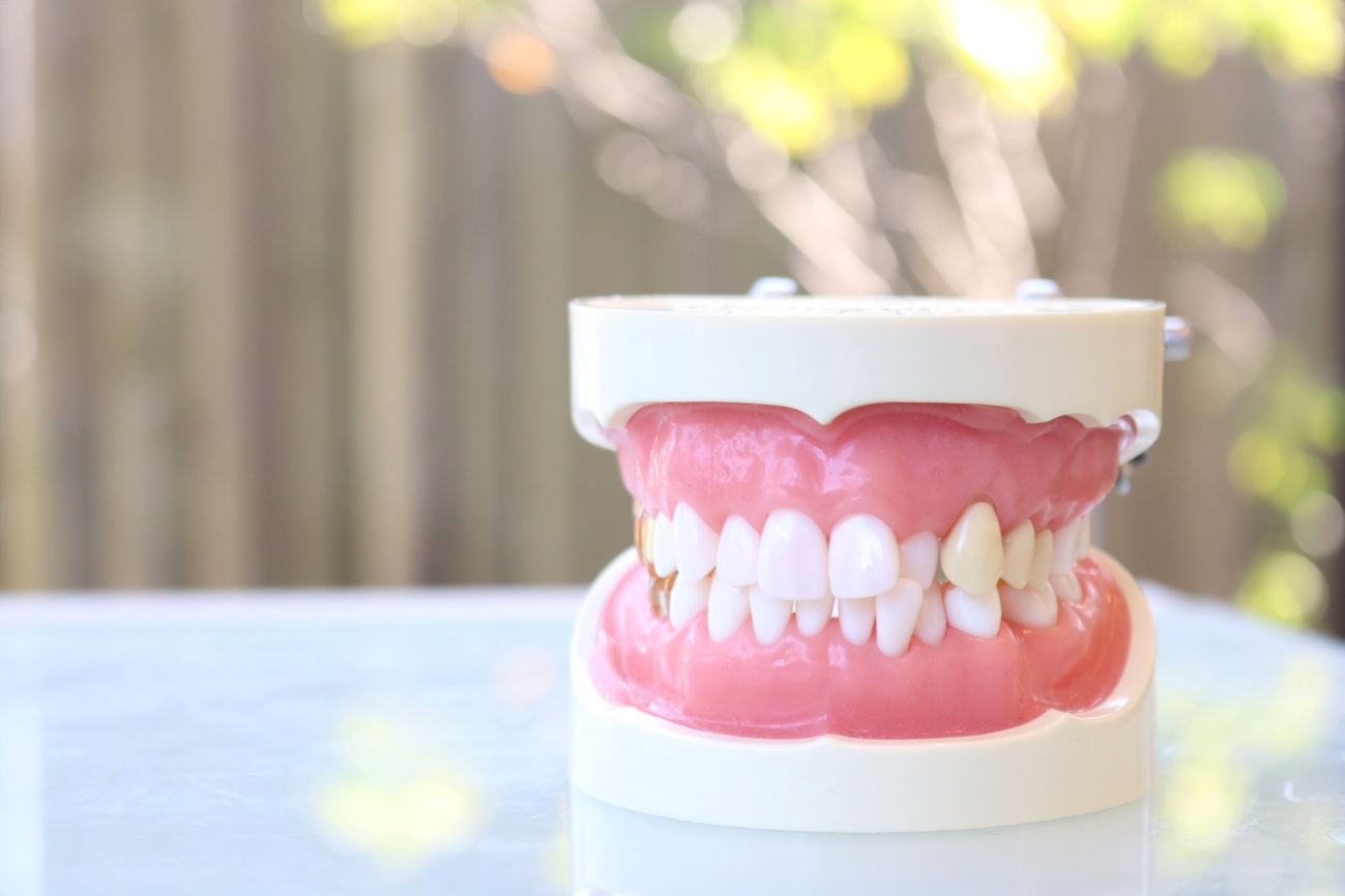 叢生（そうせい）とは？重症度や原因、矯正方法まで解説