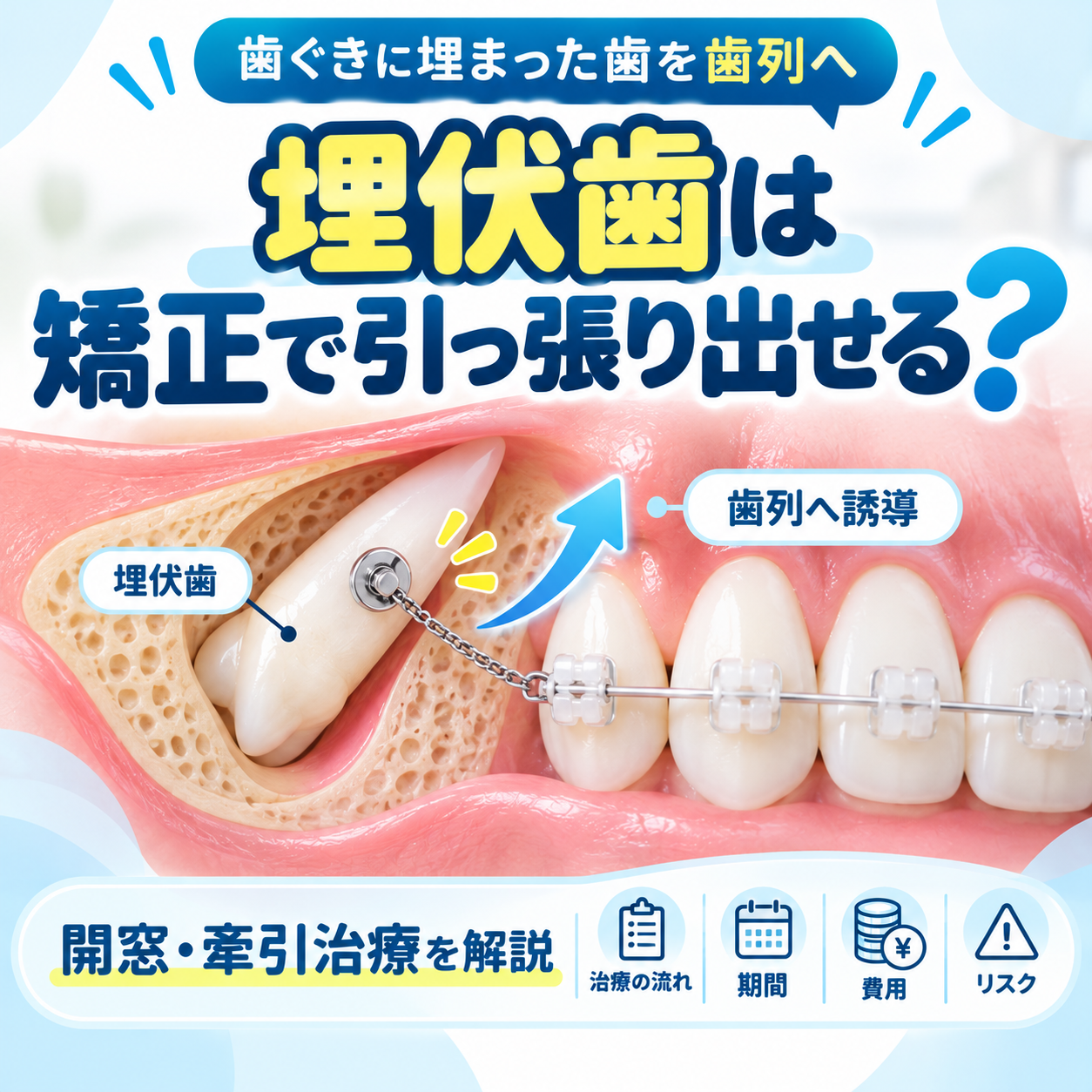 埋伏歯は矯正で引っ張り出せる？牽引治療の流れ・期間・費用・リスクを解説