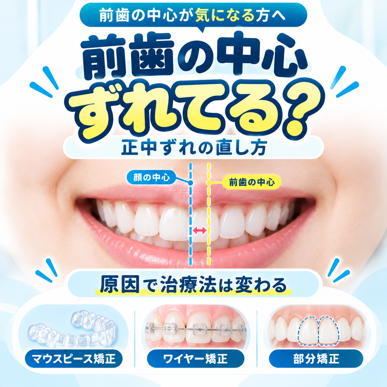 正中ずれの直し方は？原因別の矯正方法と部分矯正・マウスピースの選び方