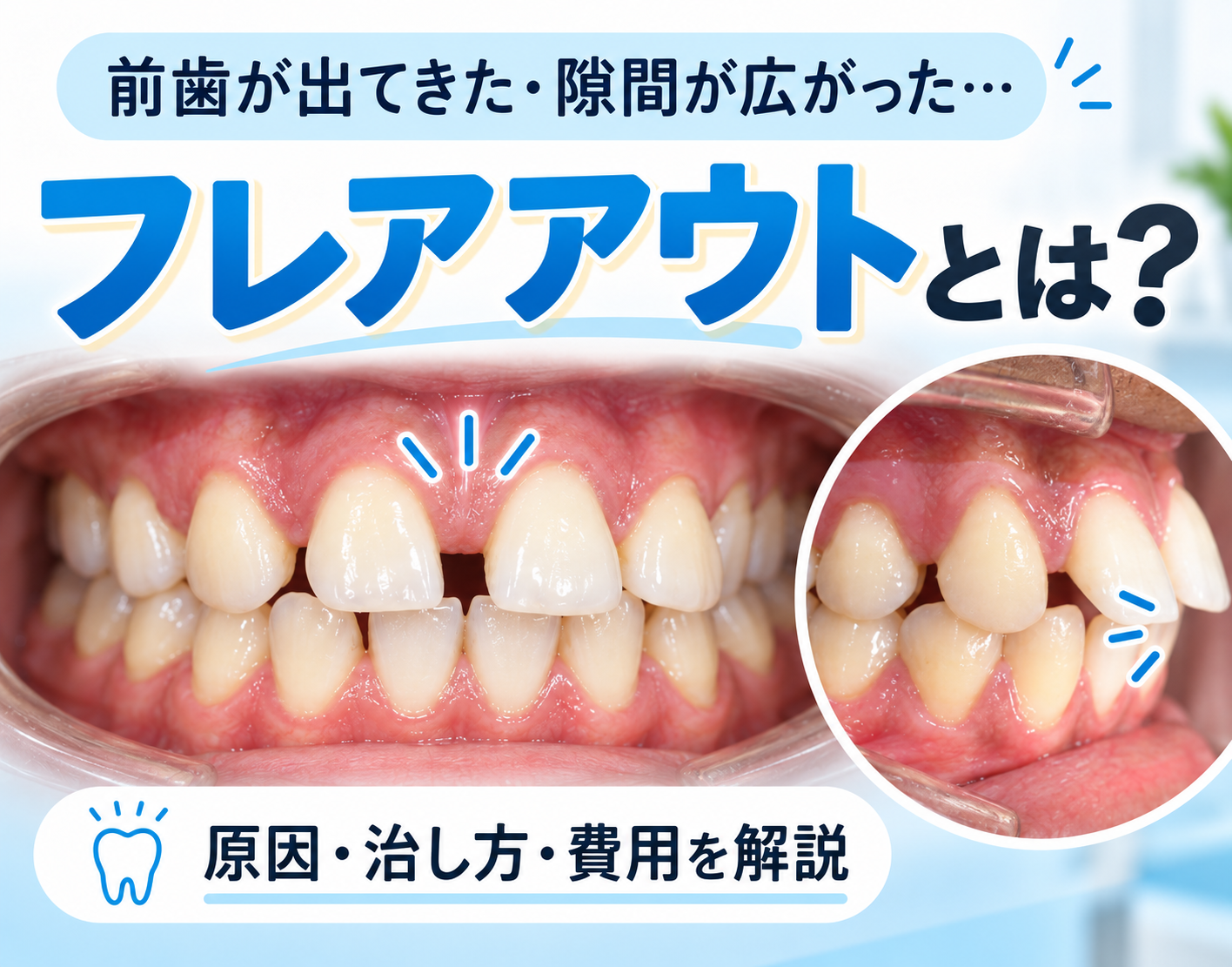 フレアアウトとは？歯科での治療法と原因・費用を解説